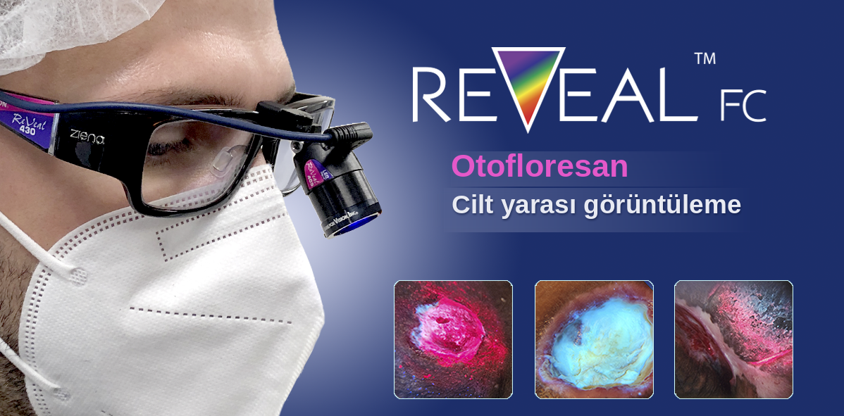 REVEAL otofloresan yara görüntüleme